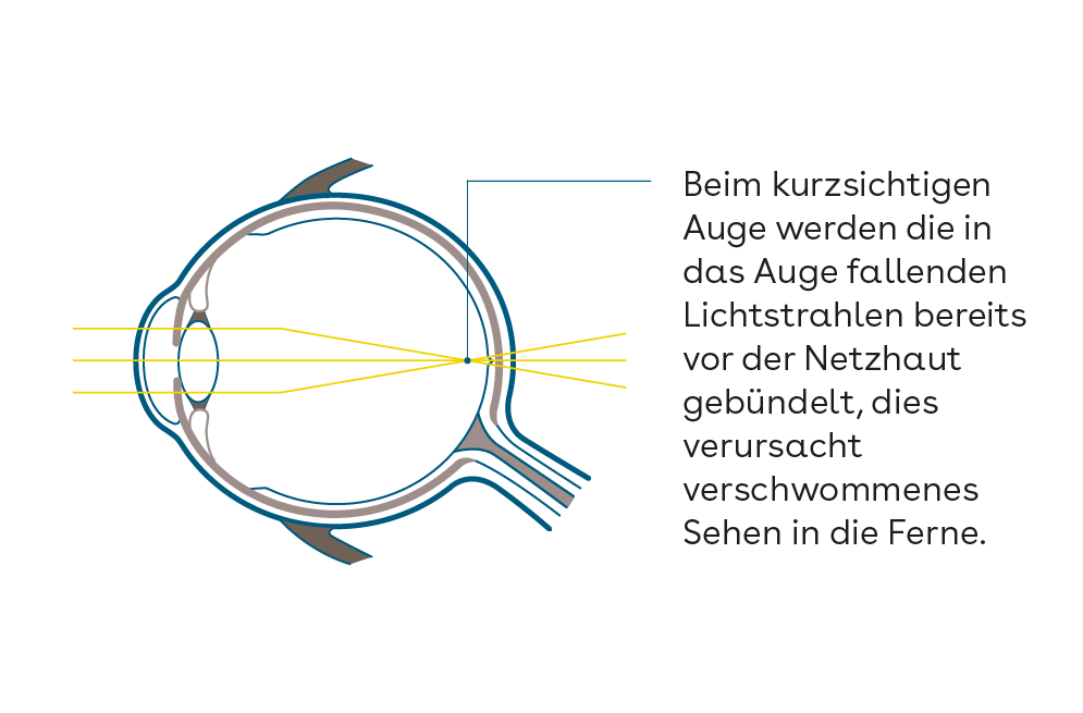 Augengrafik_buendelung_Licht