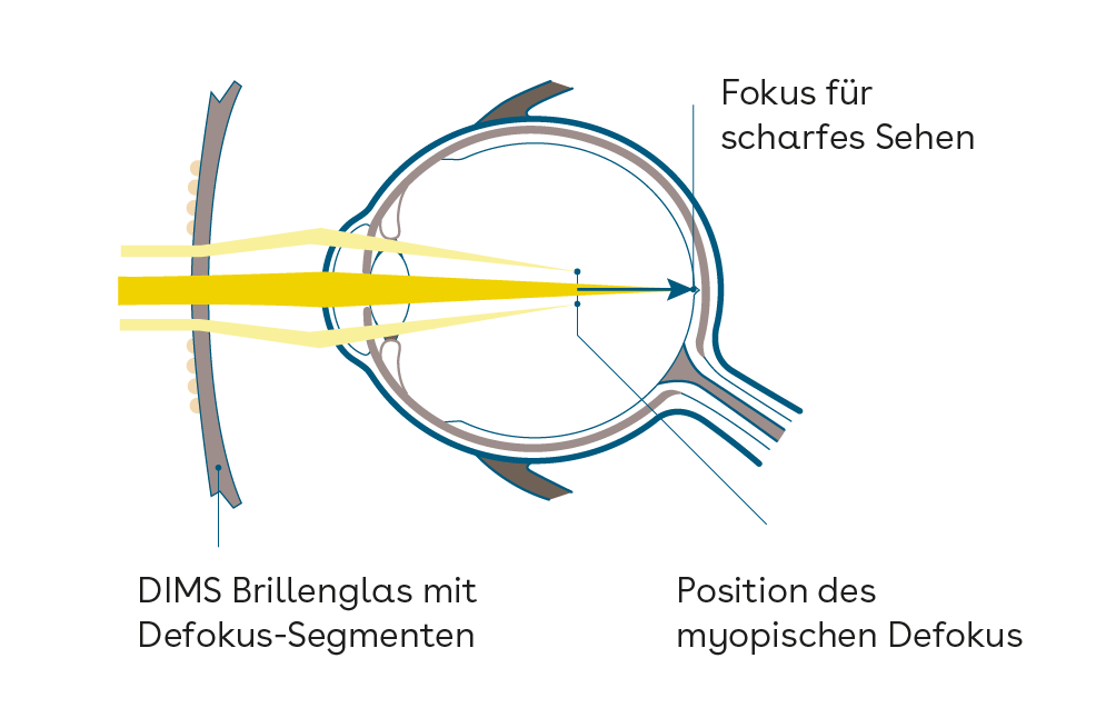 Augengrafik_myopischer_Defokus
