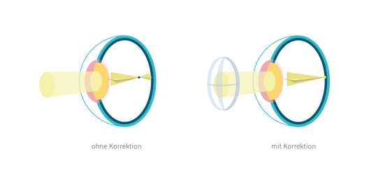 Hornhautverkrümmung-1