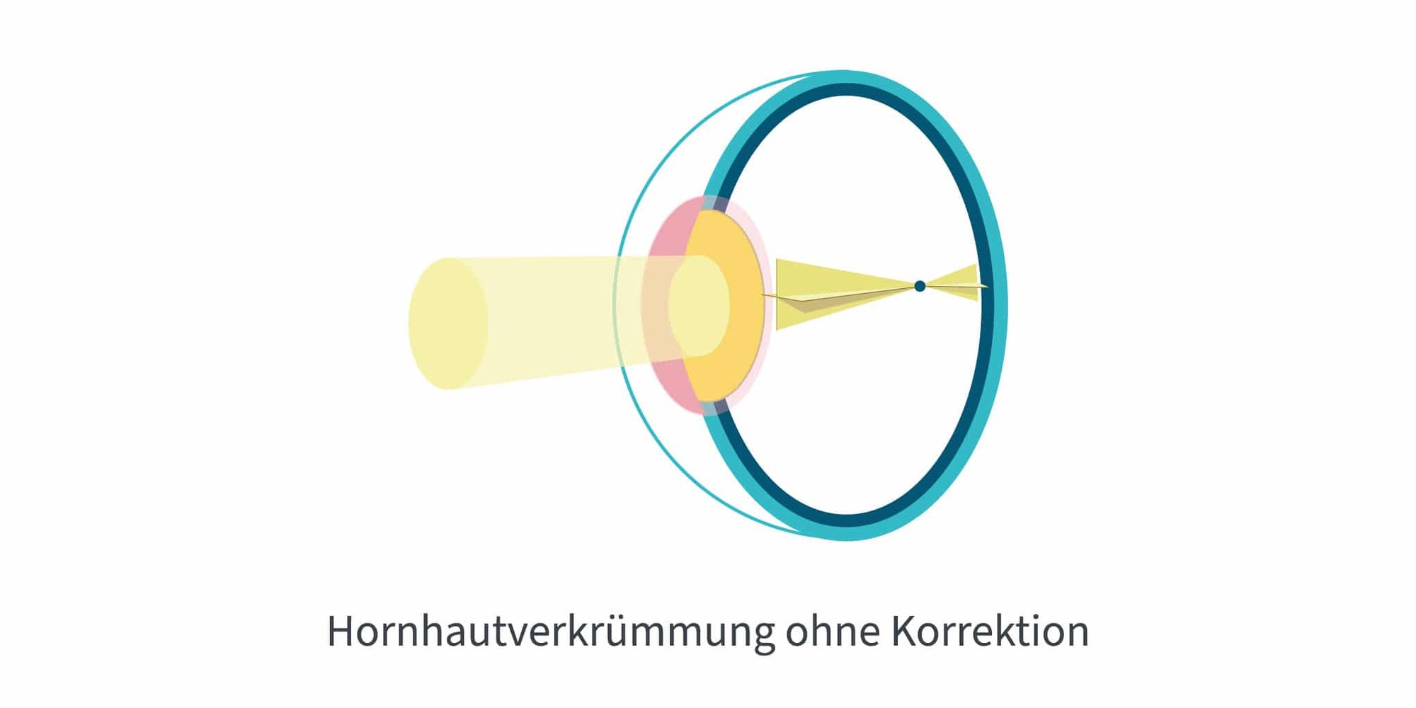 Was sind MiYOSMART Brillengläser?