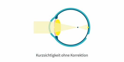 Kurzsichtigkeit_ohne_Korr