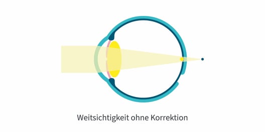 Weitsichtigkeit_ohne_Korr